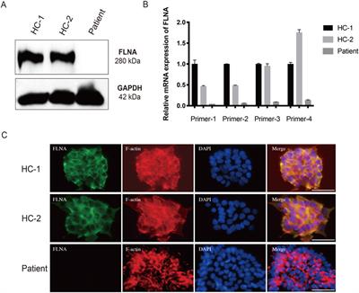 Unraveling the pathogenic mechanism of a novel filamin a frameshift variant in periventricular nodular heterotopia